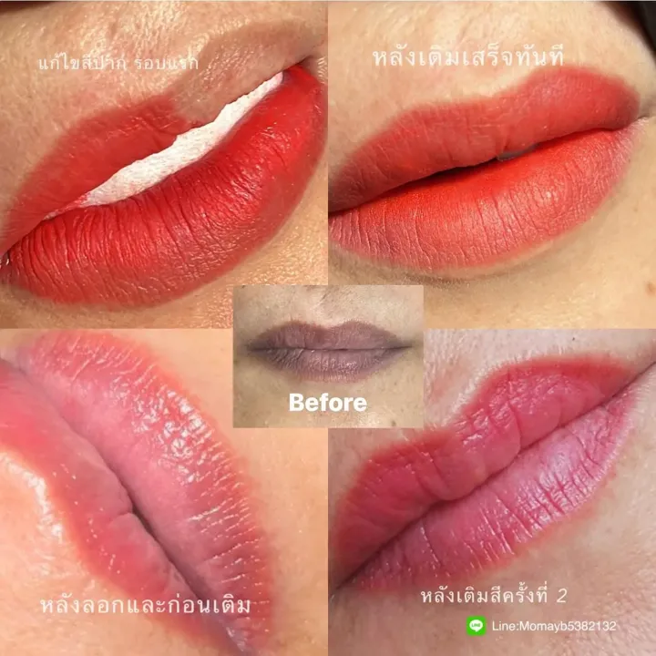 ภาพเปรียบเทียบฝังสีปาก ก่อนและหลัง