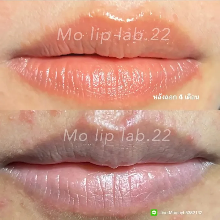 ภาพเปรียบเทียบฝังสีปาก ก่อนและหลัง