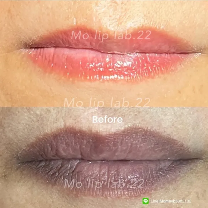 ภาพเปรียบเทียบฝังสีปาก ก่อนและหลัง