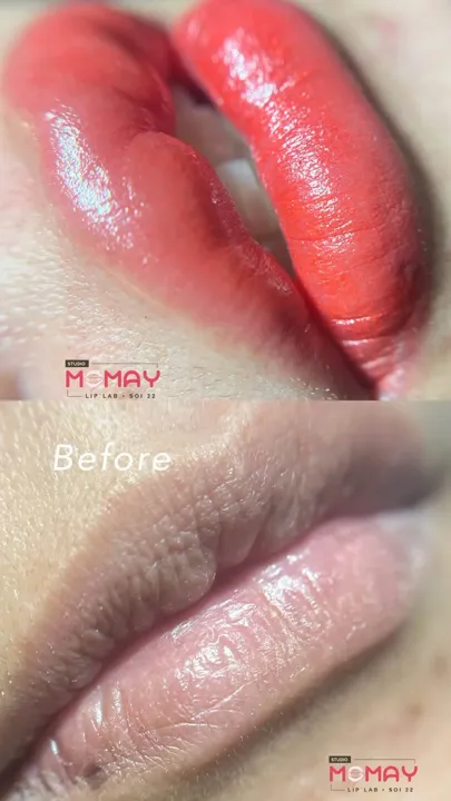 ภาพเปรียบเทียบฝังสีปาก ก่อนและหลัง