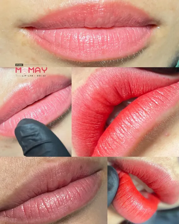 ภาพเปรียบเทียบฝังสีปาก ก่อนและหลัง